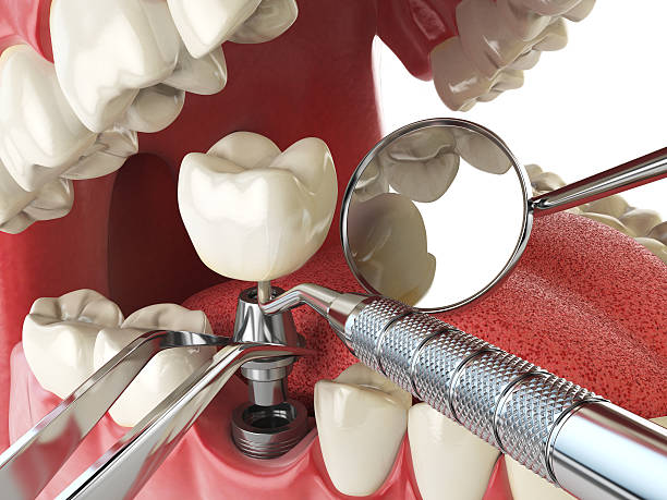 Best Emergency Dental Care for Broken or Chipped Teeth in Anaconda, MT