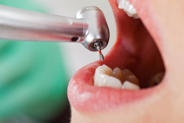 Best Emergency Root Canal Treatment in Anaconda, MT